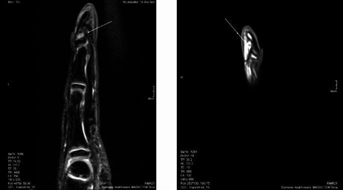 MRI of a little finger with Kirner deformity showing distal flexor tendon insertion and no inflammatory activity around the physis.