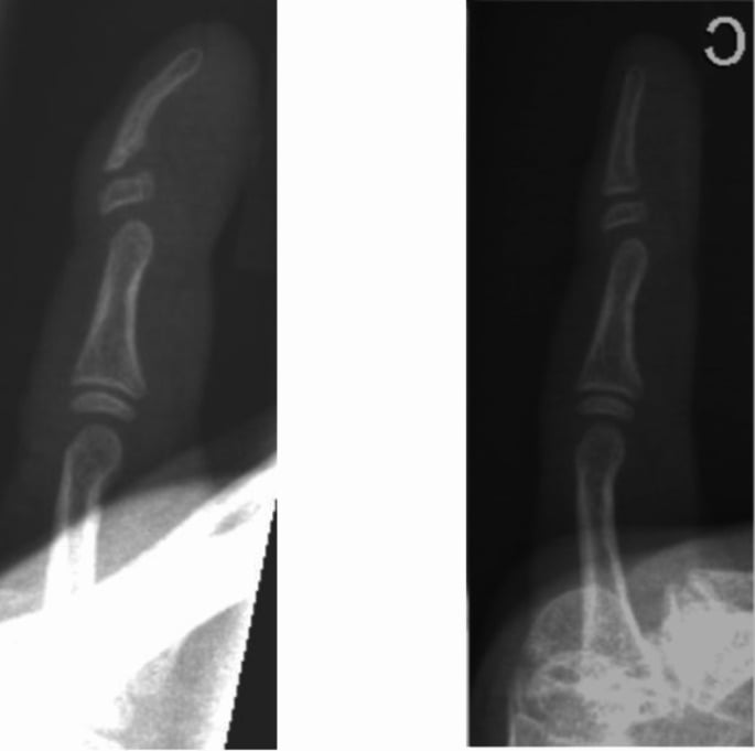 Preoperative and ten-month postoperative lateral radiographs of Kirner deformity showing the widened L-shaped distal phalangeal epiphysis and correction.