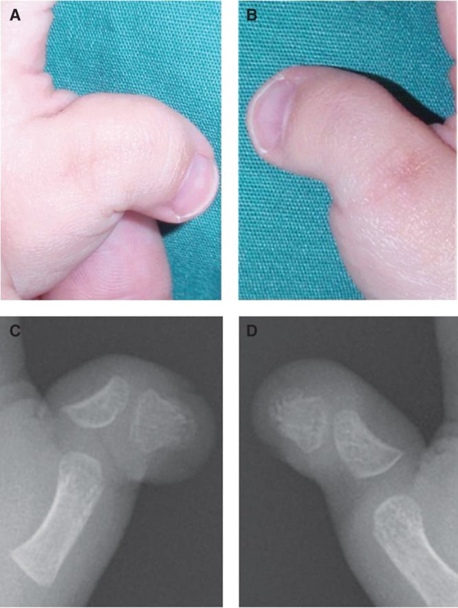 Clinical photographs and radiographs of both thumbs showing severe radial angulation from proximal delta phalanges with measured deviation angles.