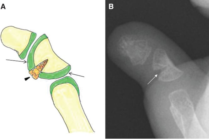 Operative images showing excision of the central longitudinal bracket physis of a delta phalanx and interposition of a local fat graft.