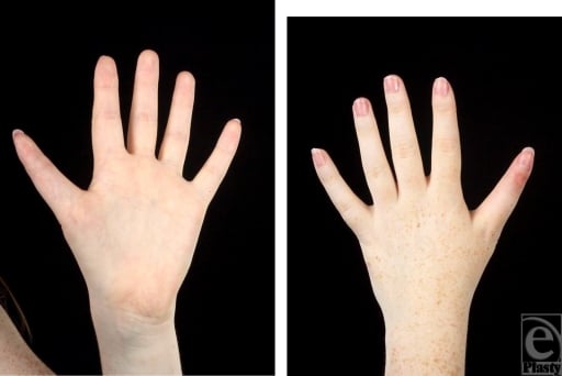 Dorsal clinical photographs of both hands twelve weeks after operative correction of bilateral triphalangeal thumbs.