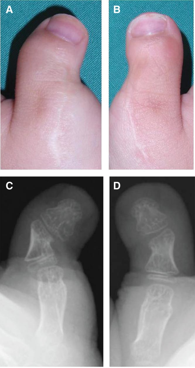 Clinical photographs and radiographs fifty-two months after bilateral thumb delta-phalanx physiolysis showing improved radial angulation.