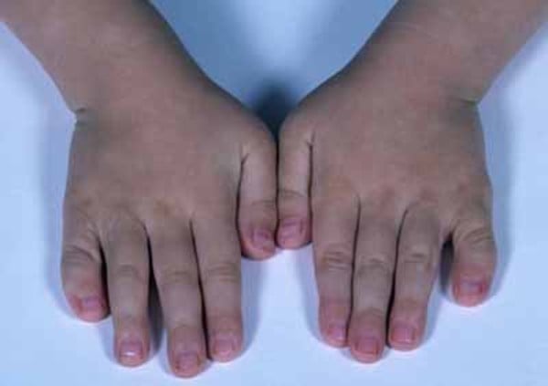 Both hands of a child showing bilateral clinodactyly with radial curvature of the little fingers.
