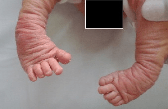 Bilateral clubfeet in a newborn.