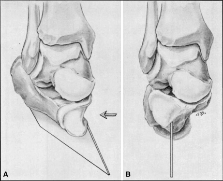 Clubfoot - Anatomical diagram composite figure of sagittal tarsal and metatarsal alignment showing deformity and correction.