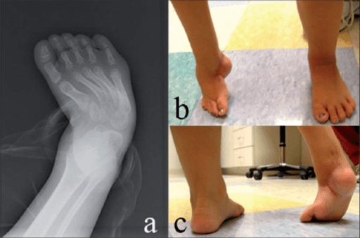 Bilateral clubfoot after Ponseti treatment - posterior view showing gait