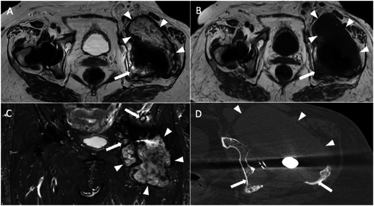 MRI and CT of particle disease around a hip arthroplasty, a large periprosthetic lesion outlined by arrowheads