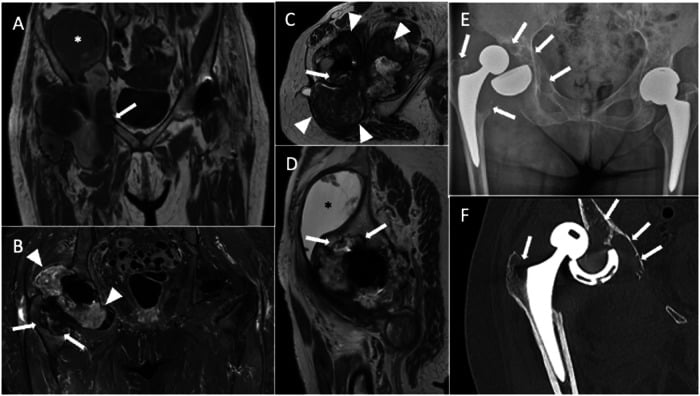 MRI, radiograph and CT of metallosis with a destructive pseudotumour around a hip replacement