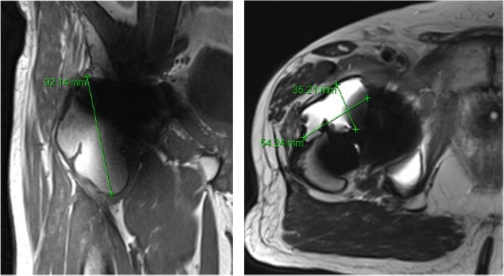 Large cystic pseudotumour on coronal and axial MRI twenty-two years after metal-on-metal THA, with calliper measurements