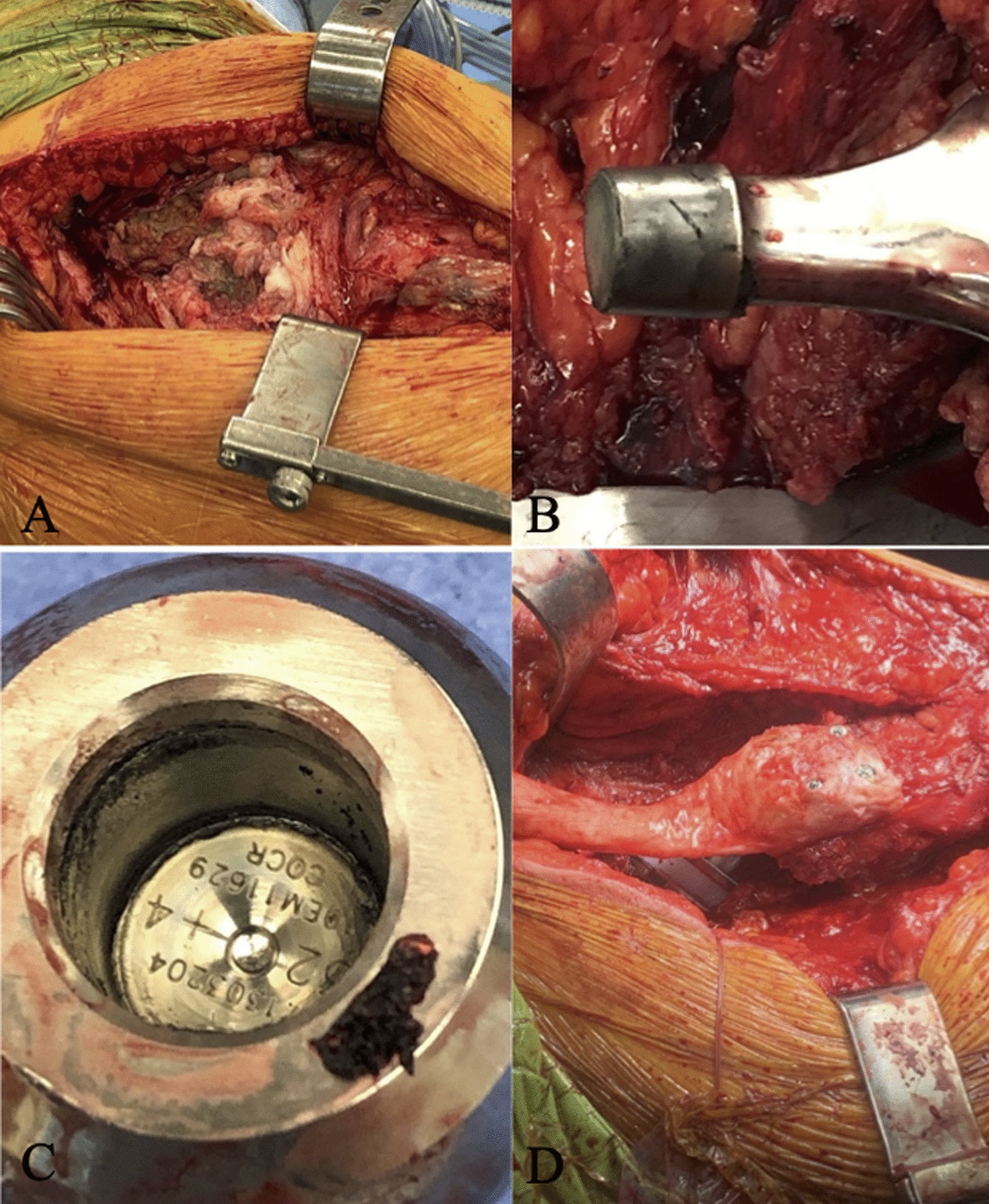 Intraoperative trunnionosis: dark tissue in the wound, a stained trunnion and black debris lining the bore of a CoCr femoral head