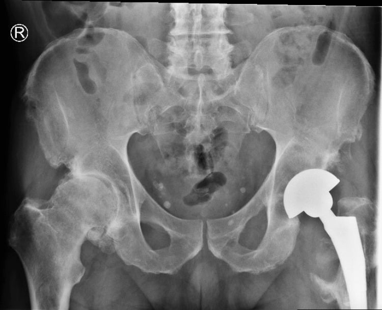 AP pelvic radiograph after revision of a left metal-on-metal THA to a ceramic head and polyethylene liner