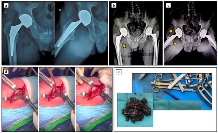 Radiographs, operative photographs and excised dark tissue in cobalt-chrome hip metallosis