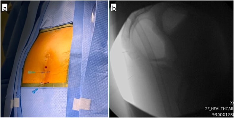 Needles placed through the prepared skin over the coccyx and the fluoroscopic image used for localisation