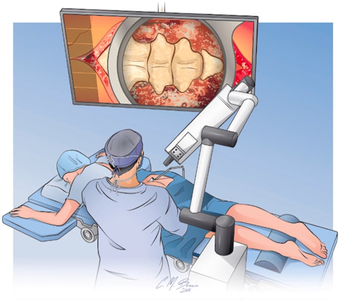 Illustration of a prone patient, the surgeon, an exoscope on an articulated arm and an overhead monitor for exoscope-assisted coccygectomy
