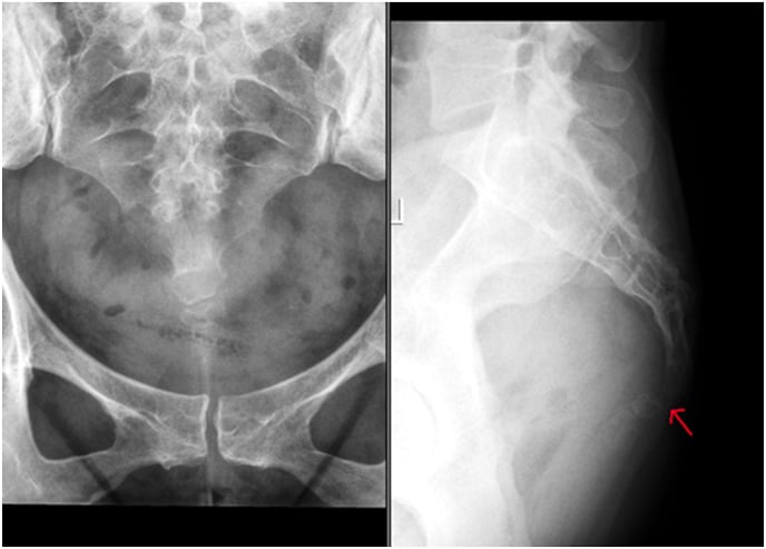 Preoperative anteroposterior and lateral pelvic radiographs with a red arrow at the coccyx on the lateral film