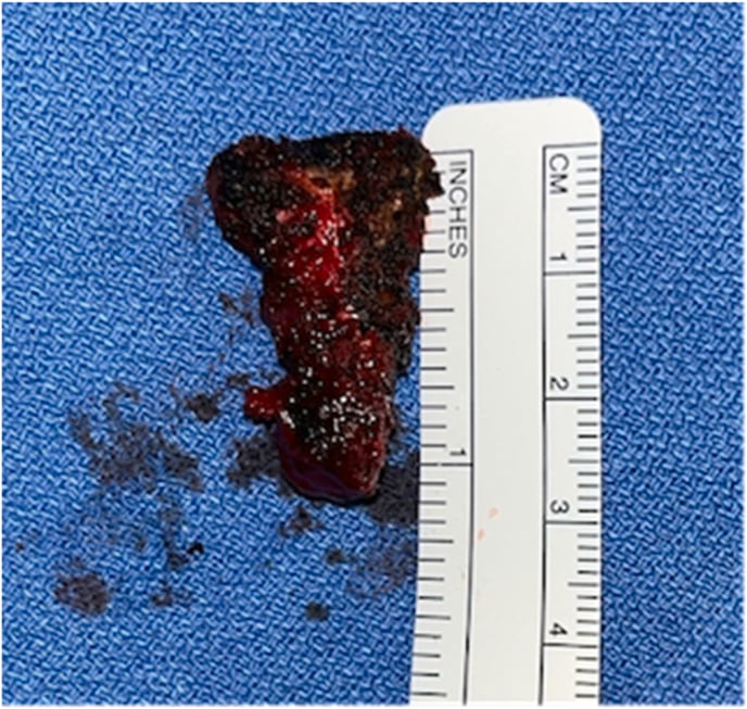Resected coccyx specimen in one piece beside a ruler marked in inches and centimetres