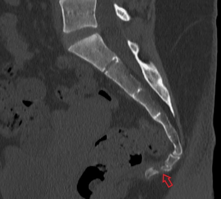 Sagittal CT scan showing coccyx fracture with fragment displacement