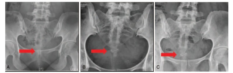 Three serial anteroposterior pelvic radiographs with red arrows at the sacrococcygeal region