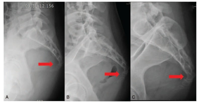 Three-panel lateral pelvic radiographs showing coccyx fracture healing progression
