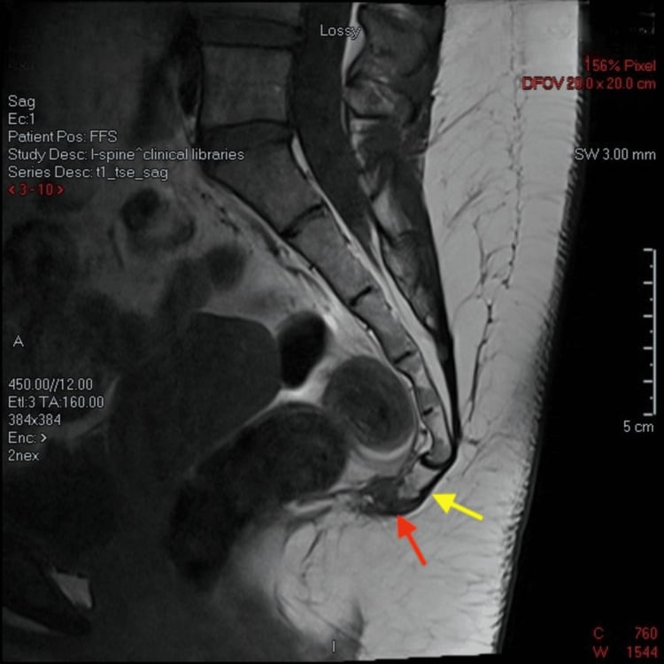 Sagittal T1-weighted MRI of the sacrum and coccyx with red and yellow arrows at a coccygeal fracture