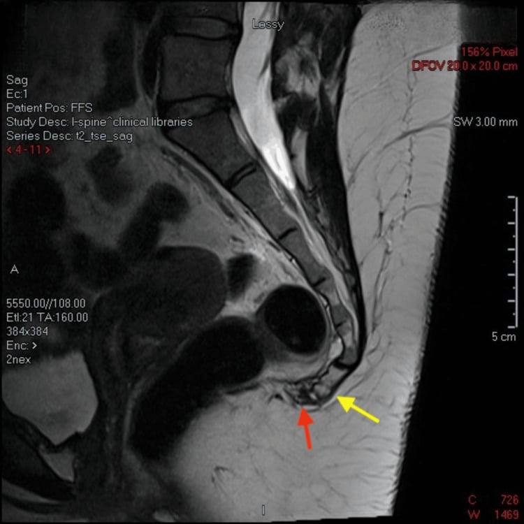 Sagittal T2-weighted MRI of the sacrum and coccyx with red and yellow arrows at a coccygeal fracture