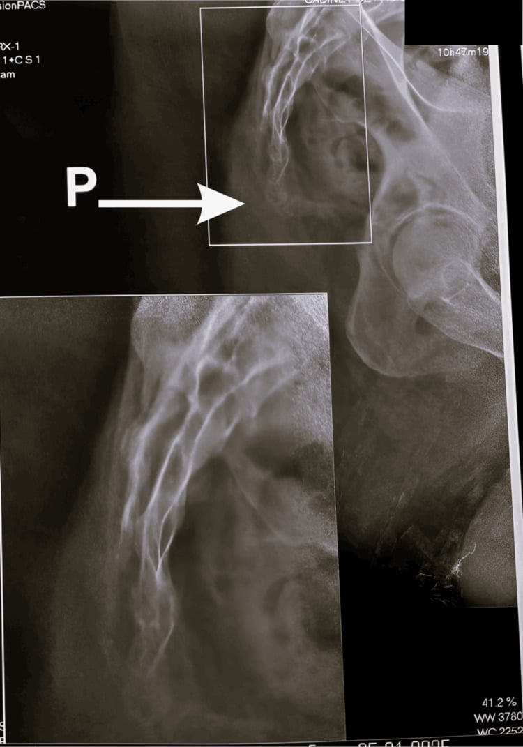 Lateral pelvic radiograph demonstrating anterior angulation of coccyx
