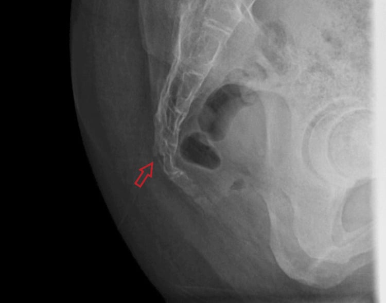 Lateral X-ray of the pelvis showing transverse coccyx fracture