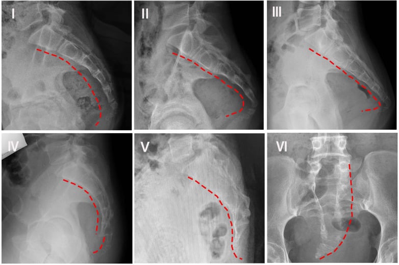 Six radiograph panels labelled I to VI, five lateral and one anteroposterior, with red dashed lines tracing the coccygeal curve