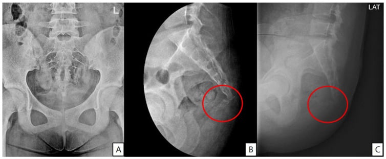 Anteroposterior pelvic radiograph and two lateral radiographs with the coccyx circled in red