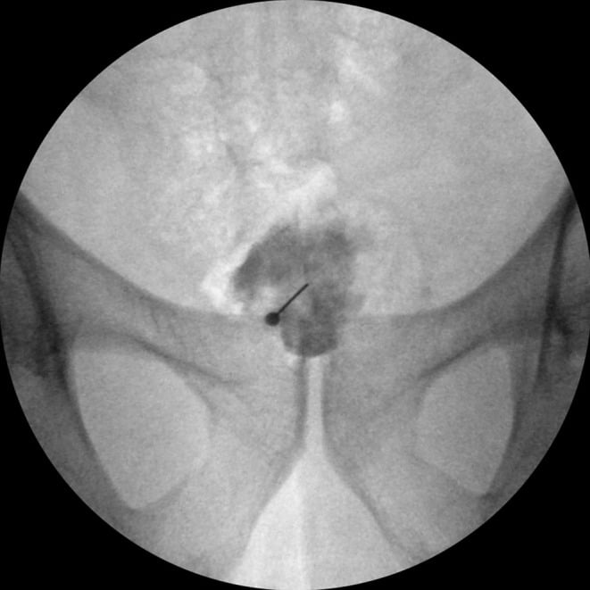 Anteroposterior fluoroscopic image of a ganglion impar block with the needle in the midline and contrast spread around its tip