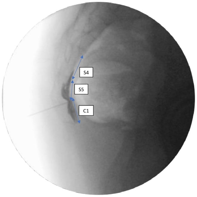 Lateral fluoroscopic image of a ganglion impar block with S4, S5 and C1 labelled and contrast along those segments