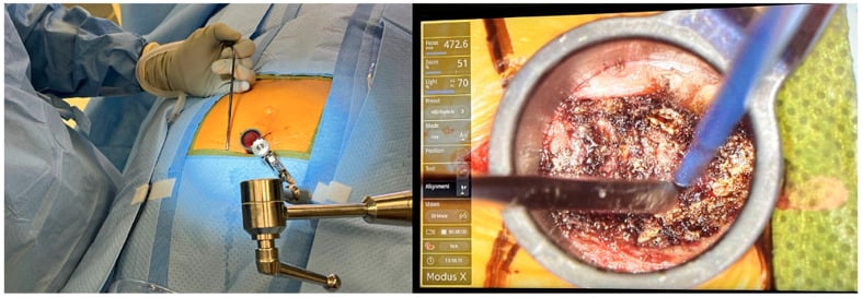 Tubular retractor on a holding arm through a small incision, and the exoscope view down the tube during minimally invasive coccygectomy