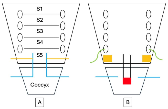 Two-panel schematic of the sacrum, labelled S1 to S5, and the coccyx, with coloured lines in panel A and coloured lines and blocks in panel B marking neural structures