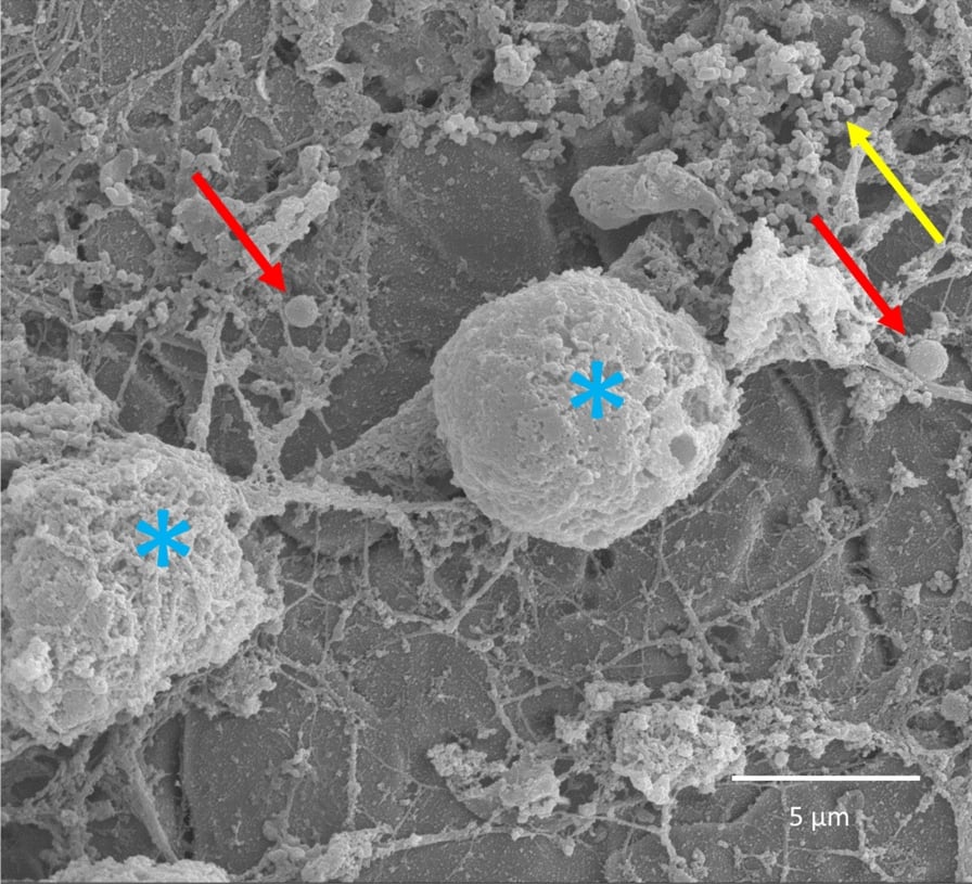 Scanning electron microscopy of Staphylococcus epidermidis biofilm on orthopaedic implant surface
