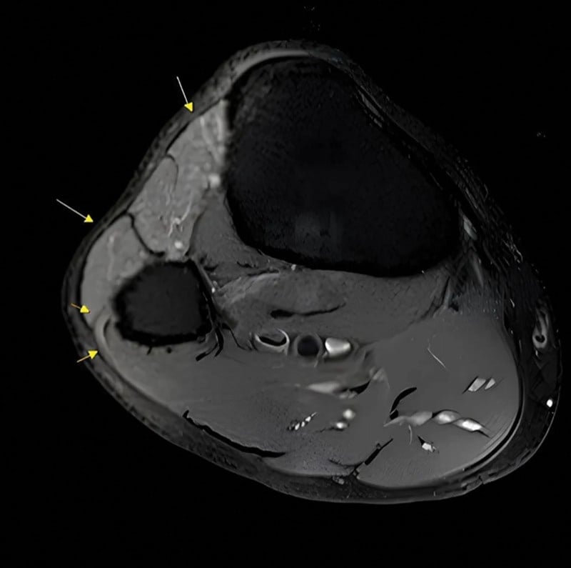 Axial fluid-sensitive MRI at the proximal leg showing increased signal in the common peroneal nerve around the fibular head and denervation oedema in the anterior compartment.
