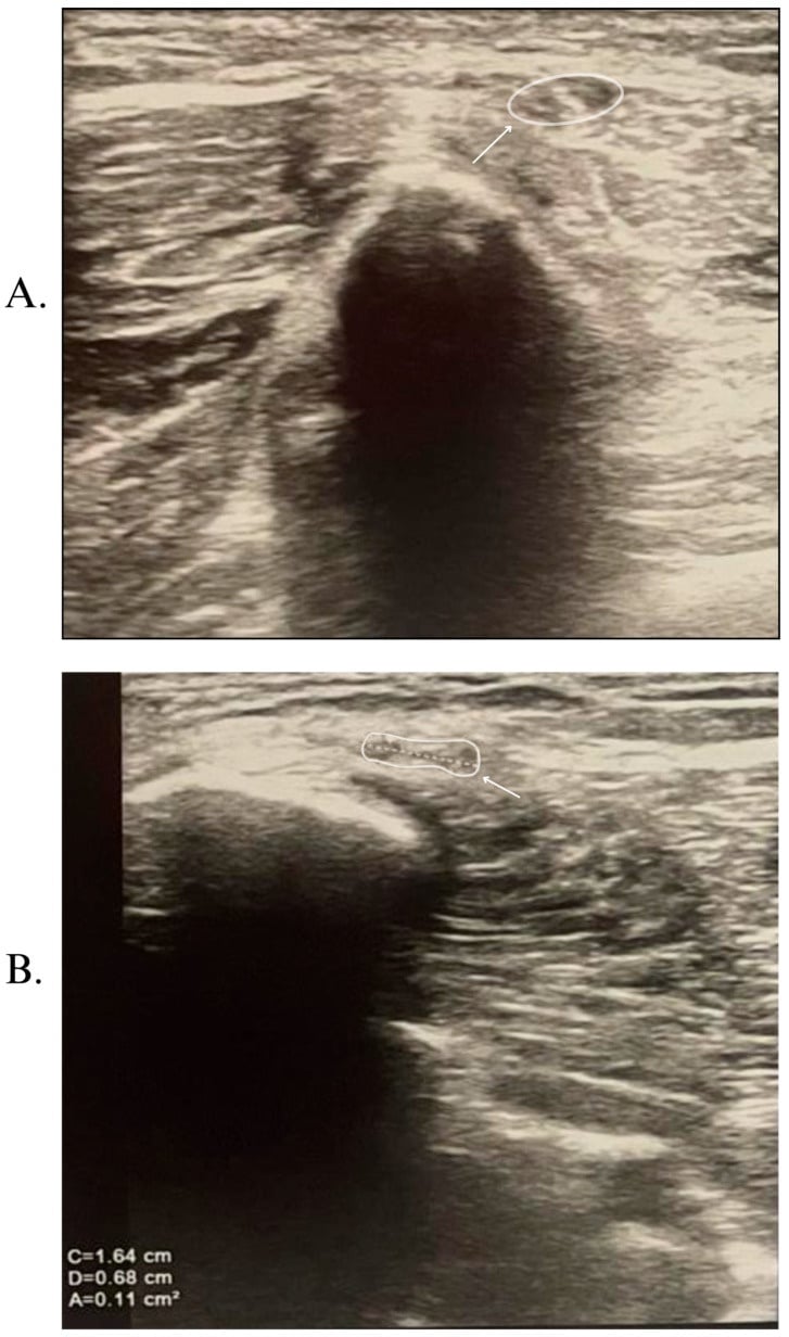 Transverse ultrasound images of the right and left common peroneal nerves at the fibular head, with the nerve outlined for cross-sectional area measurement.