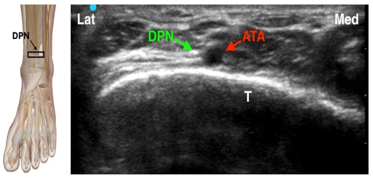 Probe-position diagram and transverse ultrasound of the deep peroneal nerve beside the anterior tibial artery over the tibia at the ankle.