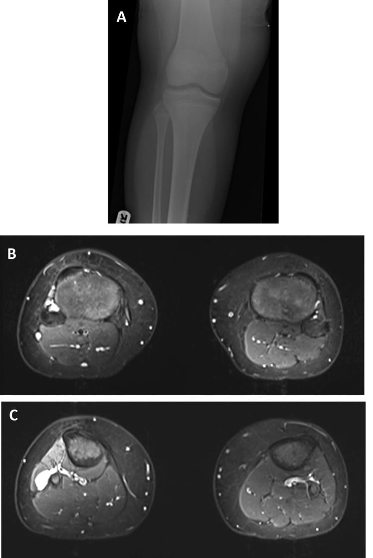 Knee radiograph and axial T2-weighted MRI showing a cystic lesion arising from the proximal tibiofibular joint in close relation to the common peroneal nerve.