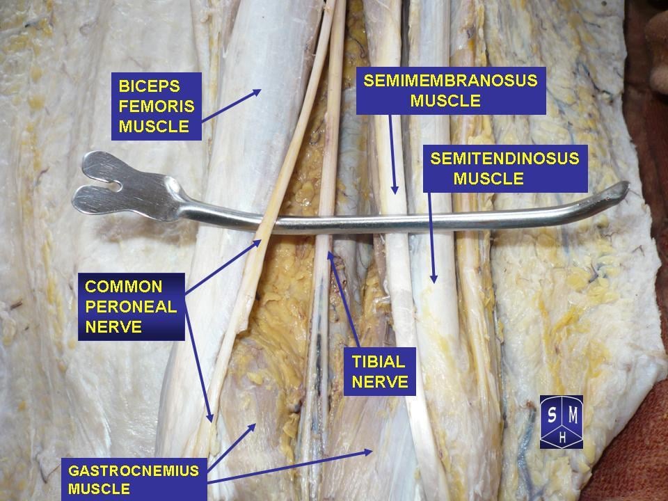 Cadaveric dissection of the popliteal fossa showing the sciatic nerve dividing into the common peroneal and tibial nerves between the hamstring muscles.