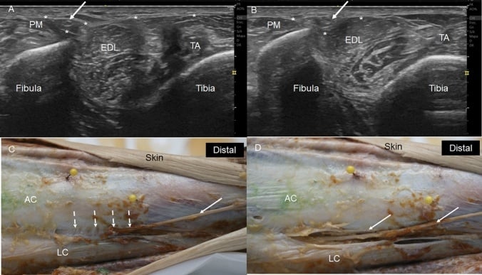Paired ultrasound and anatomical dissection views showing the superficial fibular nerve traversing the crural fascia in the distal leg.