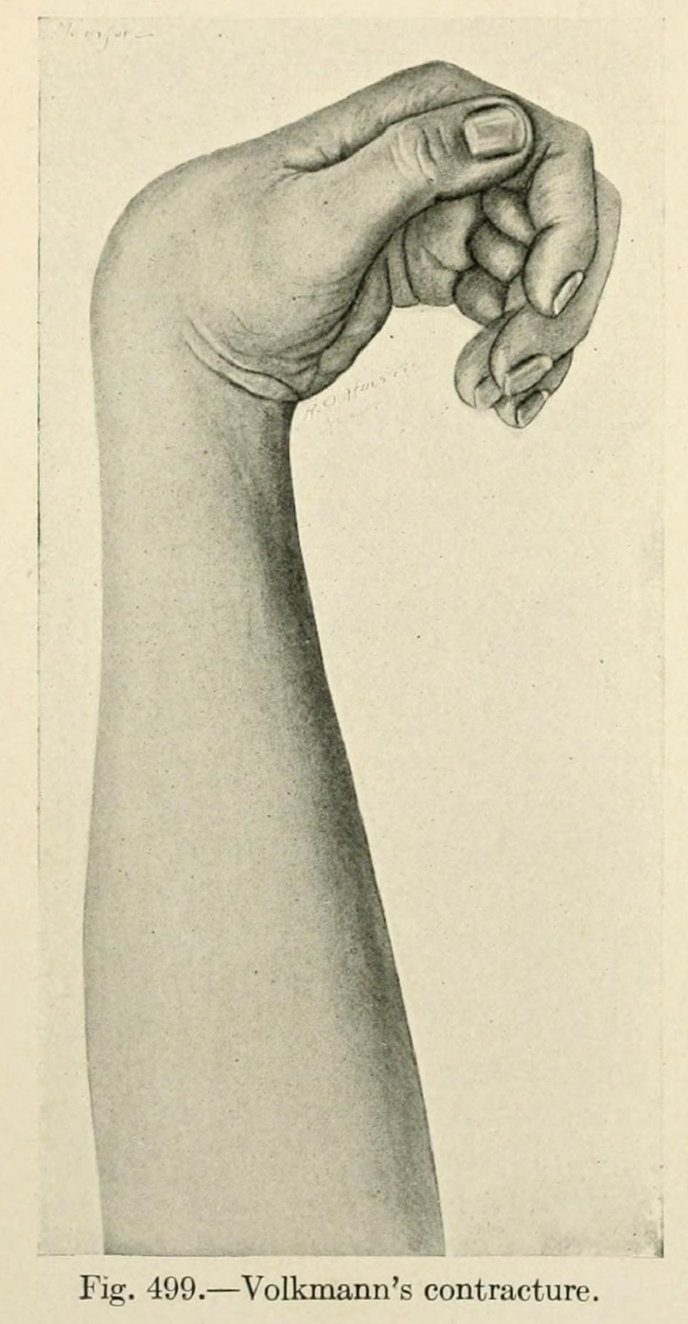 Historical illustration of Volkmann's ischemic contracture showing claw hand deformity