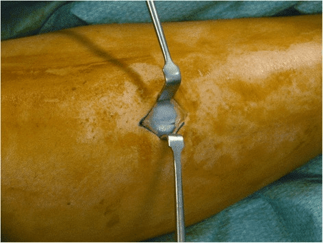 Compartment syndrome - intraoperative photograph of the limb during fasciotomy/compartment assessment.