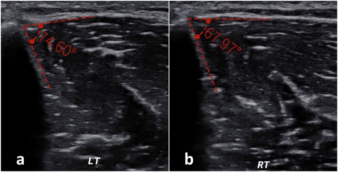 Ultrasound scan measuring tibia-fascia angle and muscle compartment herniation