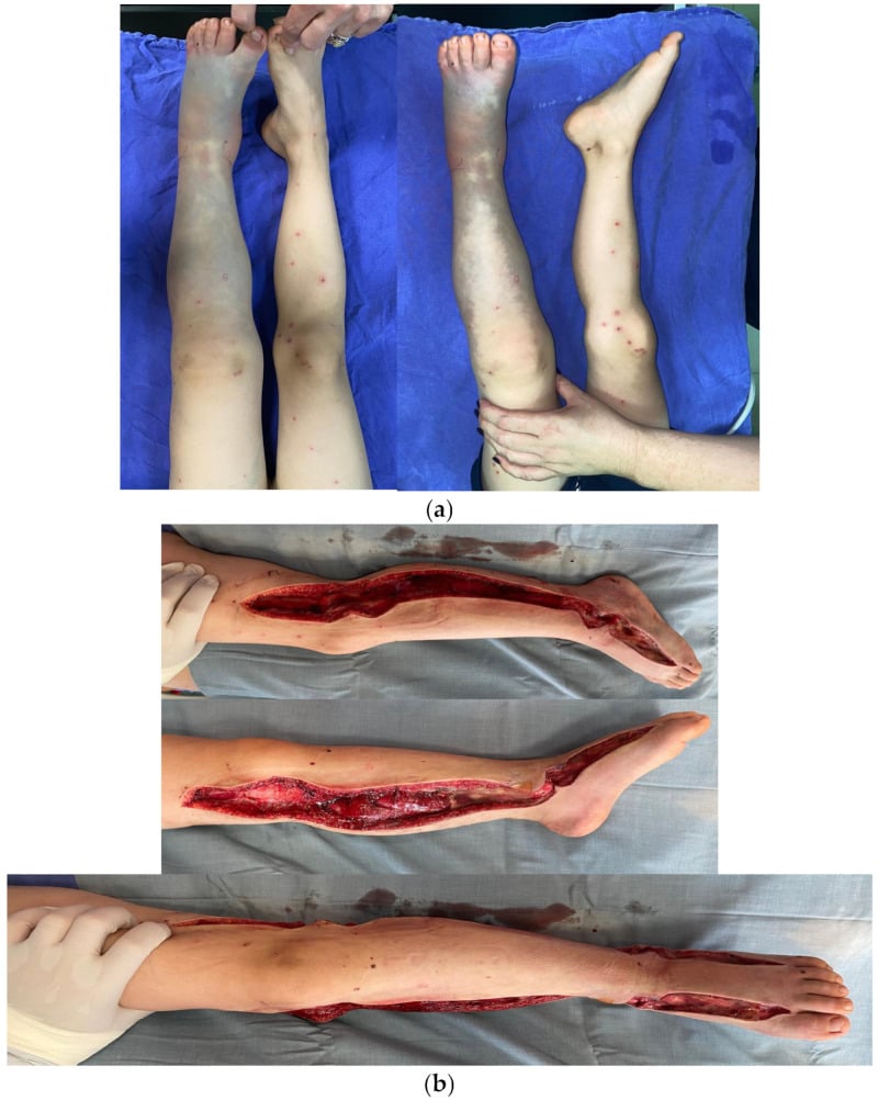 Clinical photographs of two-incision four-compartment leg fasciotomy