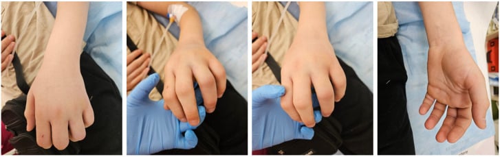 Clinical photograph demonstrating upper limb compartment syndrome and Volkmann contracture