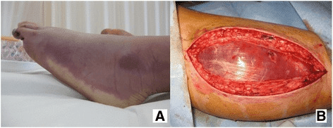 Two-panel clinical photographs showing acute compartment syndrome and fasciotomy surgical technique