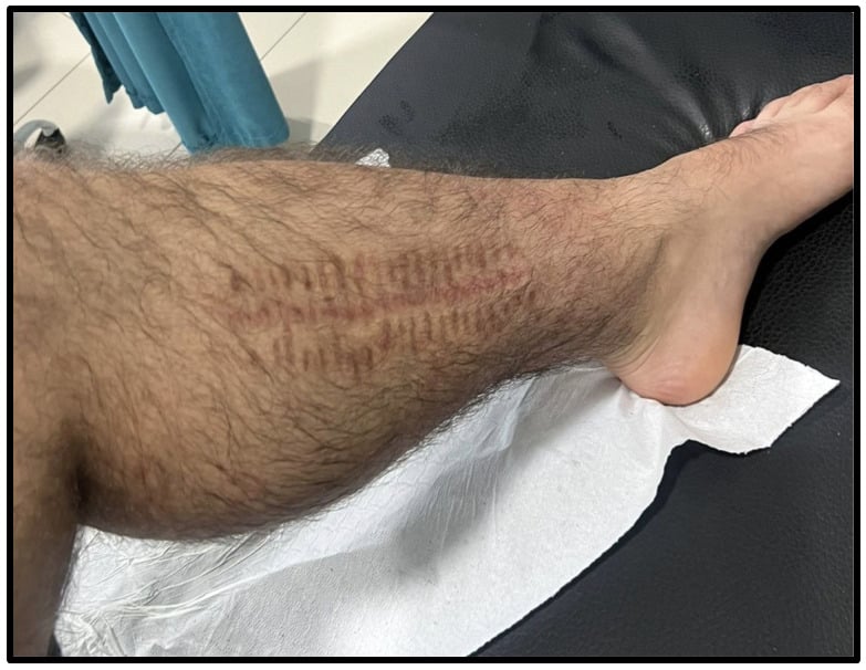 Clinical photograph showing a healed lower-leg fasciotomy scar six months after surgery.