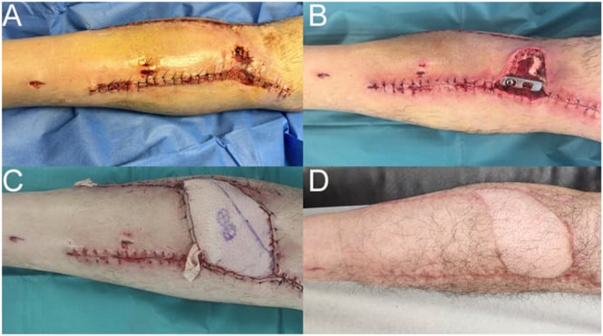 Serial photographs showing fasciotomy wound closure, dehiscence and soft-tissue flap coverage after tibial plateau fracture.