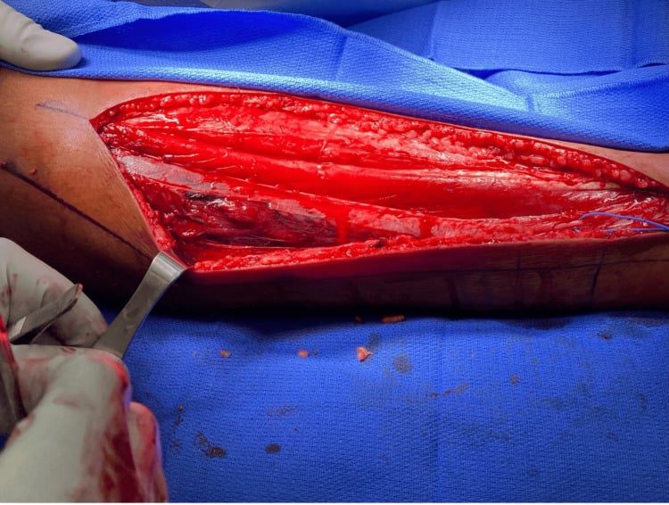 Intraoperative photograph of an anterolateral leg fasciotomy showing exposed viable muscle.