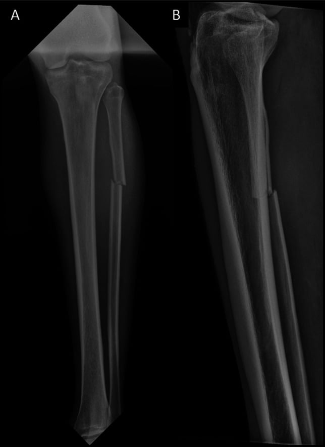AP and lateral radiographs showing an isolated fibular shaft fracture.